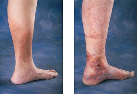 Varicose Veins Rash Pictures Symptoms And Pictures
