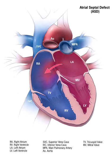 Atrial Septal Defect Facts Congenital Heart Defects Ncbddd Cdc