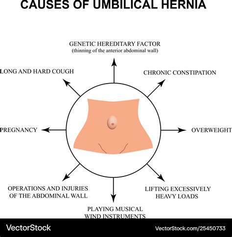 Stomach Hernia Types