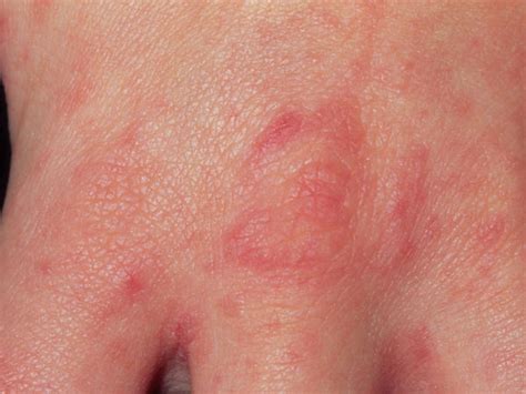 Childhood Rashes And Skin Conditions Photos Babycenter India