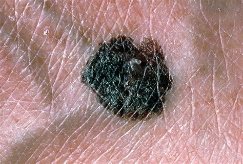 Malignant Melanoma Blemish On Foot Of Patient Photograph By Dr P