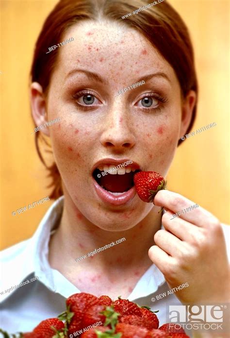 Woman With Allergy Eating Strawberries Stock Photo Picture And Rights