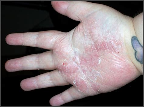 Psoriasis On Hands Pictures Psoriasis Expert