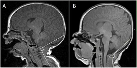A—sagittal T1 Weighted Mr Image Of Head Neck Region Of A Newborn Infant