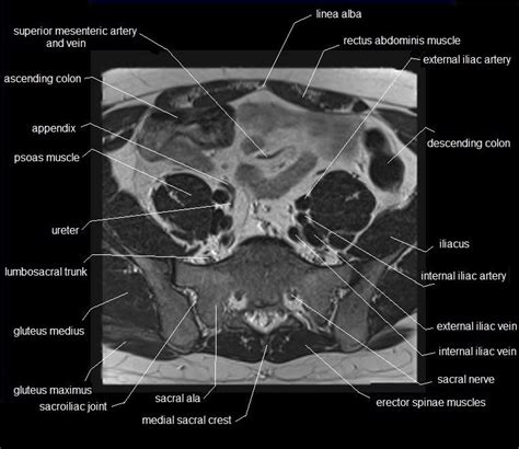 mri hip anatomy - Google Search | Human anatomy chart, Pelvis anatomy