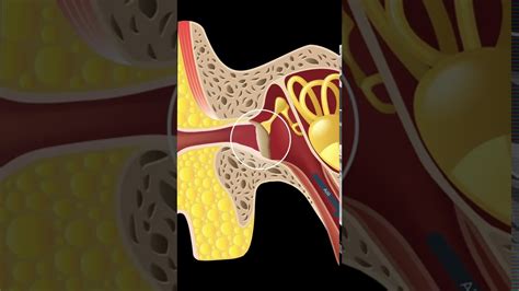 Retracted Eardrumretraction Pockets Explained Shorts Youtube