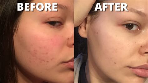 How To Get Rid Of Acne Scars And Fade Dark Spots And Hyperpigmentation On