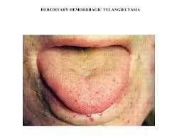 Frequent nosebleeds are common, but telangiectases in. Hereditary hemorrhagic telangiectasia | Switzerland| PDF | PPT| Case Reports | Symptoms | Treatment