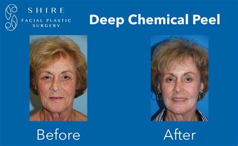 Deep Chemical Peels Before And After Shire Facial Plastic Surgery