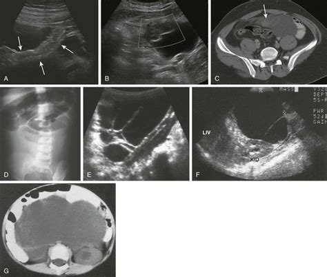 Congenital And Neonatal Abnormalities Radiology Key