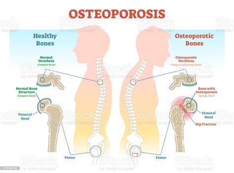 Backbone boilerplate & grunt bbb *. Osteoporosis Examples Vector Illustration Diagram With ...