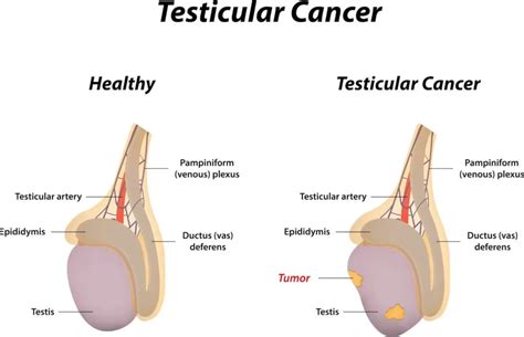 Testicular Cancer Symptoms Diagnosis And Treatment Singapore