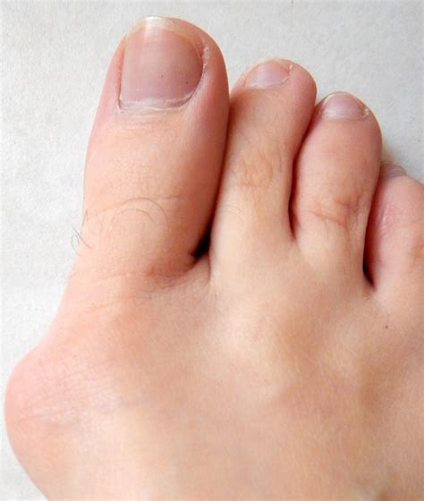 Bunion Laser Treatment Does It Work Vancouver Podiatry