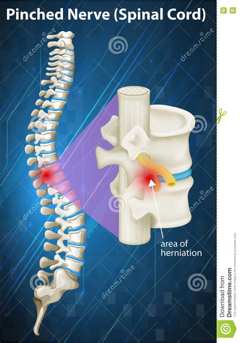 Diagram Of Pinched Nerve At Spinal Cord Cartoon Vector Cartoondealer