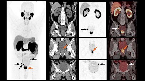 Differentiation Of A Rib Benign Lesion From A Metastasis Using Xspect Quant