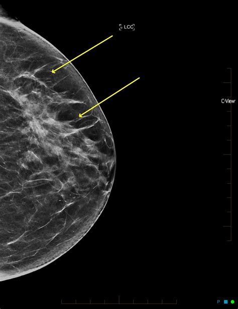 Cureus Large Non Enhancing Breast Cancer On Breast Magnetic Resonance
