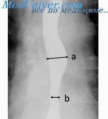 Диета при лейомиоме пищевода Короткий пищевод. Удвоения пищевода Короткий пищевод. Удвоения пищевода Диета при лейомиоме пищевода