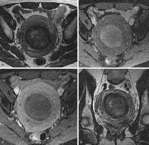 Magnetic Resonanceguided Ultrasound Surgery Of Uterine Leiomyomas
