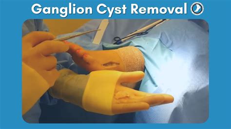 Ganglion Cyst Removal Youtube