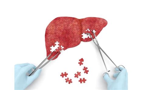 Liver Transplant Guidelines Procedure And Indications Tips