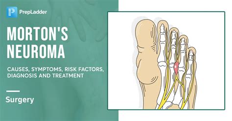 Mortons Neuroma Causes Symptoms Risk Factors Diagnosis And Treatment