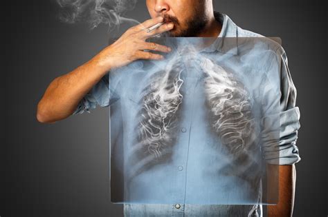 15 august 2019 next review due: Lung Cancer - Its Symptoms, Tests and Treatment Methods