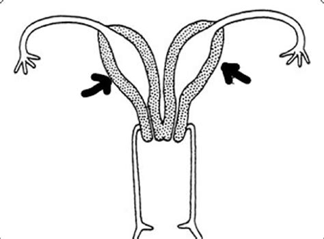 Illustration Of Uterus Didelphys In Our Clinical Case The Arrows Are