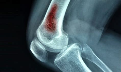 Osteomielitis Infección Del Hueso ¿qué Es Y Cómo Se Cura