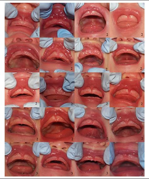 Figure From The Superior Labial Frenulum In Newborns What Is Normal