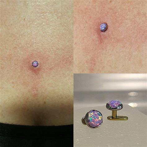 Belly Button Piercing Keloid Removal