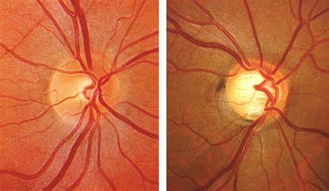 Glaucoma Treatment Olson Optical Optometrist In Saint James Mn