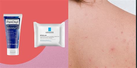 6 Products Dermatologists Recommend For Body Acne Self