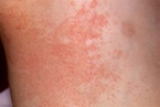 Heat rash (prickly heat) - NHS