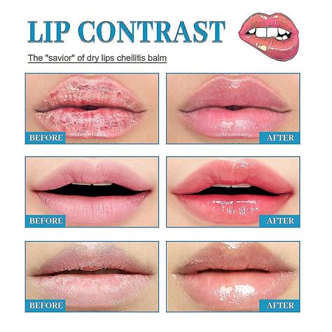 Cheilitis Cream Inflammation Labial Herpes Antibacterials Chapped Lips