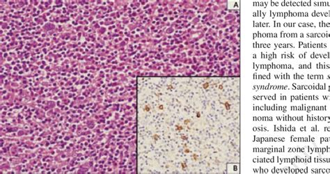 A Figure Showing Mixed Cellular Population In Hodgkin Lymphoma With