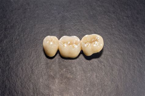 Ceramic Tooth Crowns And Metal Pins Close Up Macro Orthopedic
