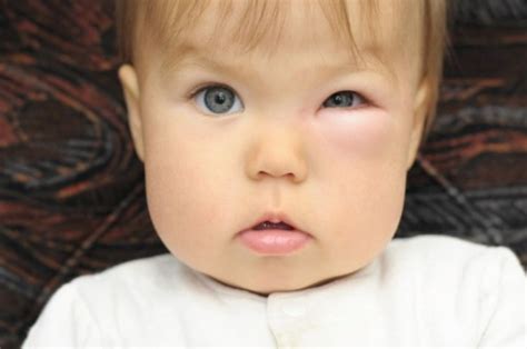 One Red Spot On Toddlers Face Flexorleditlanzas Diary