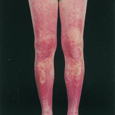 Carbamazepine Induced Vasculitic Rash On The Lower Legs The Rash On