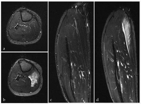 Axial Ab And Coronal Cd T2 Weighted Fat Suppressed Mri Images Of