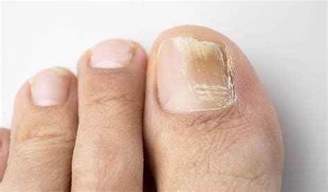 Fungal Nails Onychomycosis Nail Infections Causes And Treatments