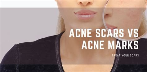 Acne Scars Vs Acne Marks Treat Your Scars