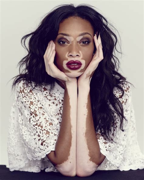 Supple Magazine Blog Winnie Harlow Who Is Living With