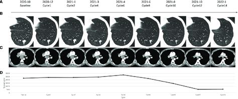 A Timeline Of The Reported Case B Chest Computed Tomography Ct