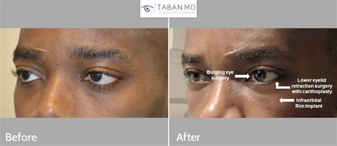 Eyelid Retraction Surgery Before And After Photos Taban Md