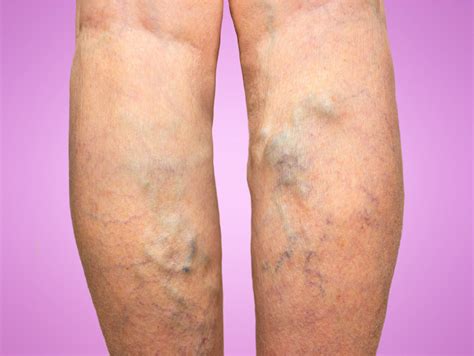 Varicose Veins Causes Symptoms Diagnosis And Treatments