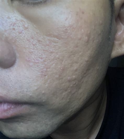 How Do I Treat Tiny Bumps All Over My Face How Much Do Those Treatments Cost Photo Human