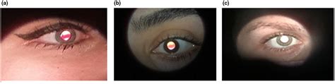Revisiting The Oil Droplet Sign In Keratoconus Utility For Early