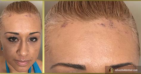 Frontal Fibrosing Alopecia How Women Are Conquering Their Hairline