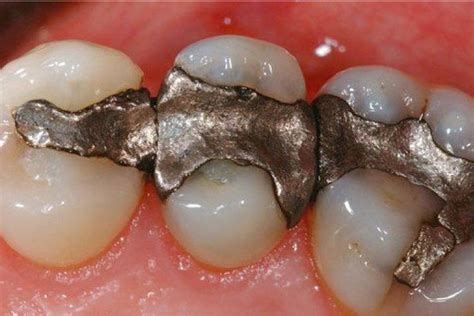 Piyush verma dept of pedodontics & preventive dentistry. Dangers of Amalgam Dental Fillings | Smiles Dental | NW ...