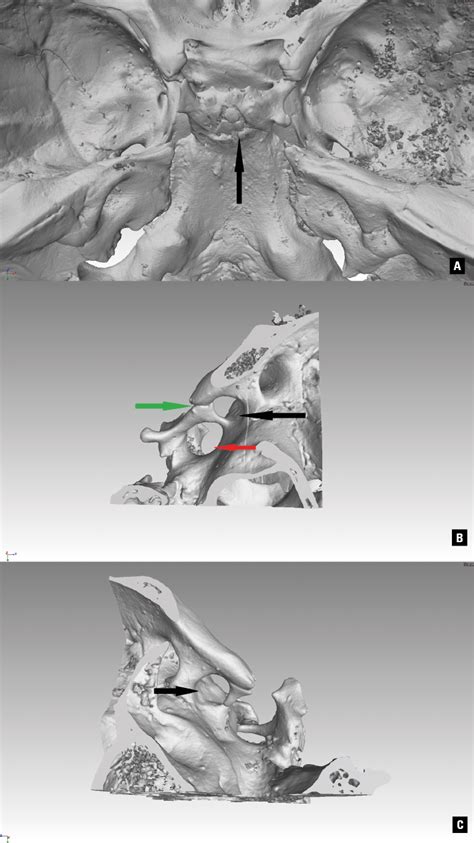 Metopic Skull With Occipitalisation Of The Atlas Nikolova Folia
